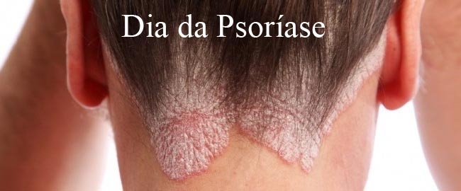 SAÚDE: Dia da Psoríase