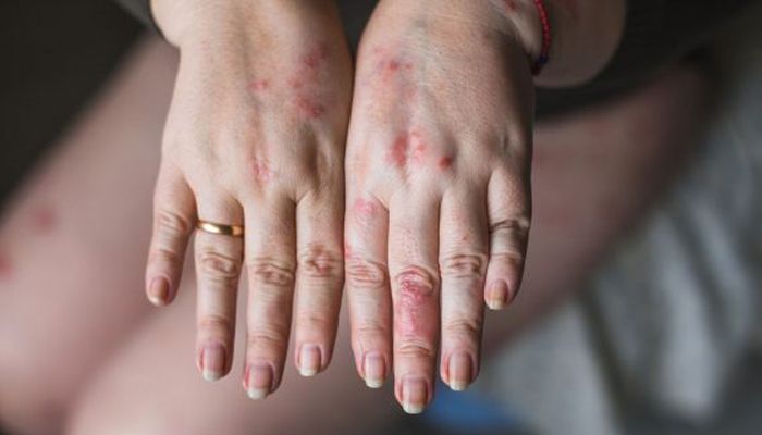 CONSCIENTIZAÇÃO: Encontro Anual de Pessoas com Psoríase 2019
